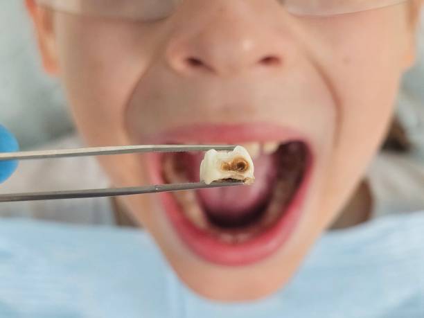 Best Chipped Tooth Repair Near Me  in Henagar, AL